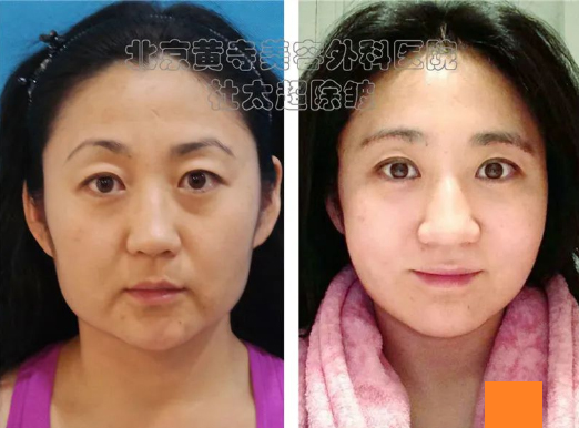 眼周衰老这么做! 眼周衰老这么做!