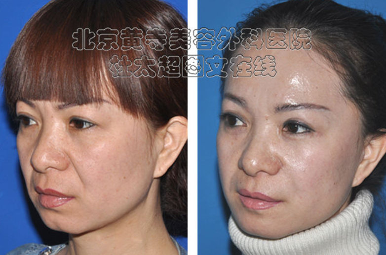 手术去除眉间纹能保持多久