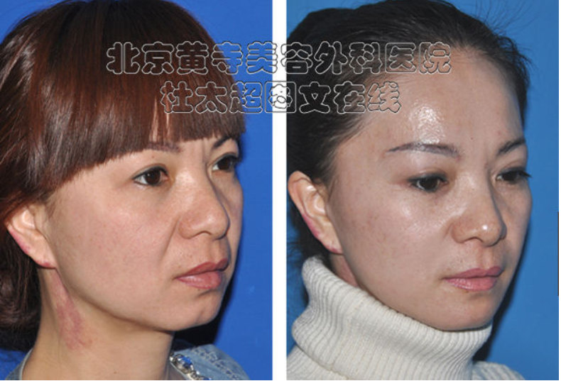 怎么消除川字纹