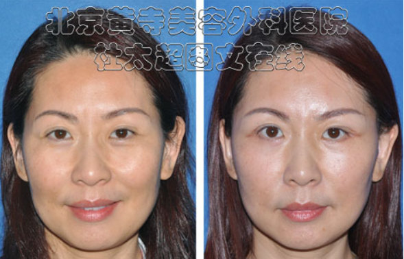 脸部提升术后注意什么