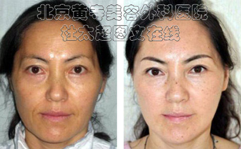 玻尿酸去额头纹效果怎么样