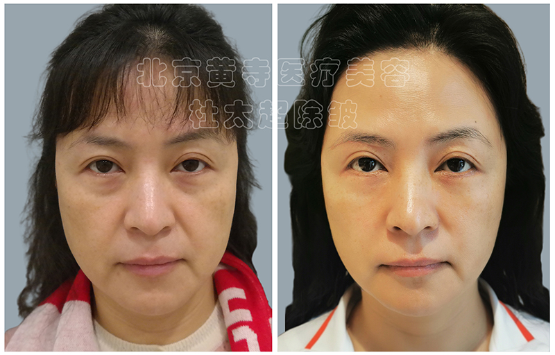 哪些人做完小切口拉皮效果更好？