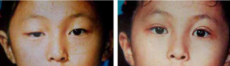 上睑下垂有哪些类型