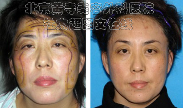 面部提升术哪种最有效