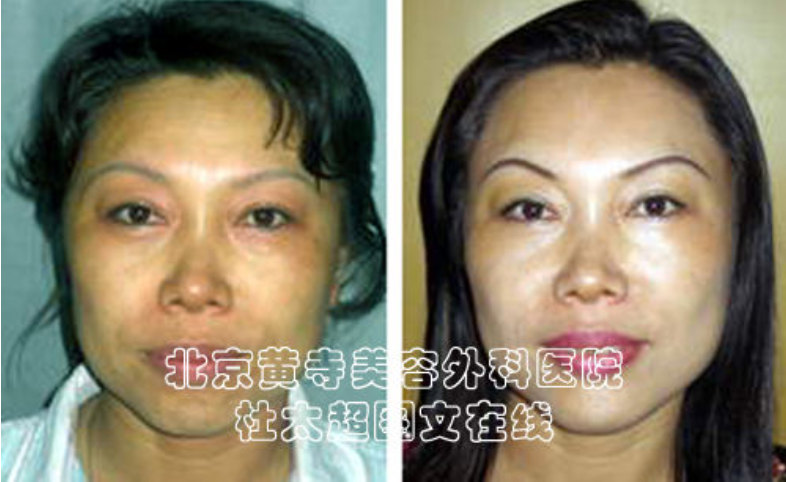 去除额头上皱纹的好办法