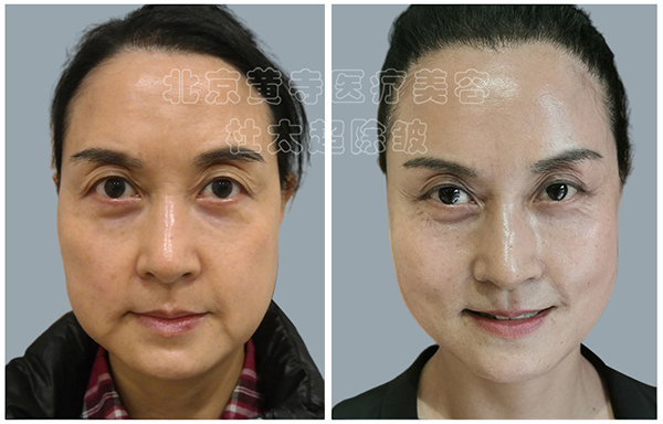 改善是做提升好还是填充好? 改善是做提升好还是填充好?