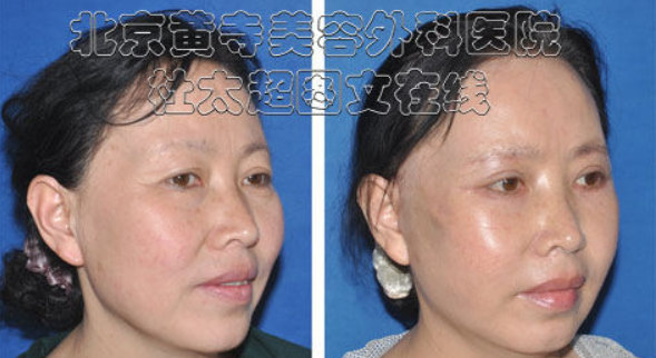 面部提升术效果到底怎么样