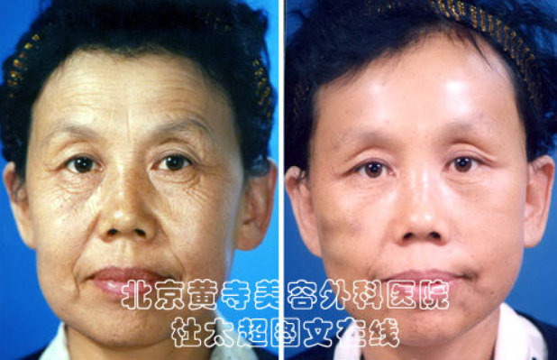 怎样去除眼部皱纹最有效