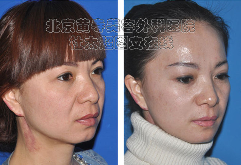 怎样消除川字纹