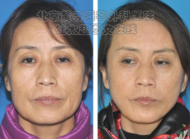 有什么办法可以祛除眉间的川字纹