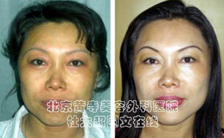 额纹祛除术的注意事项