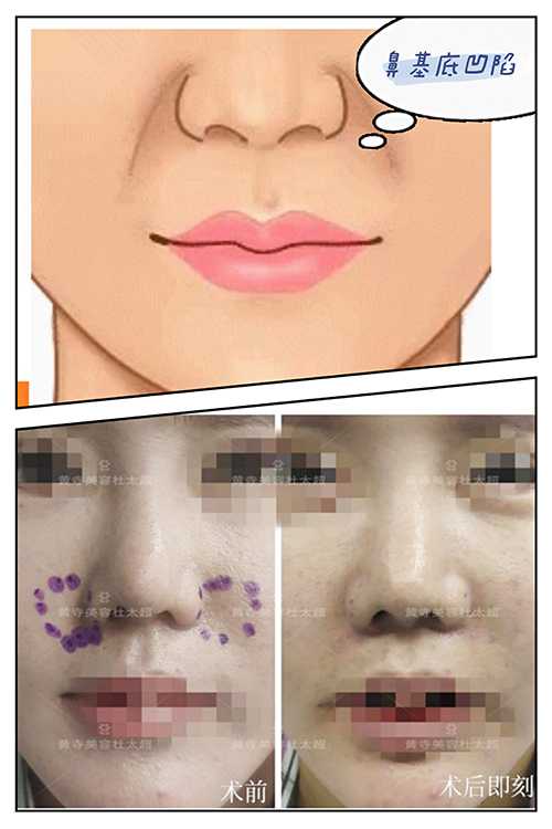 先天性导致的结构性型法令纹（鼻基底凹陷）