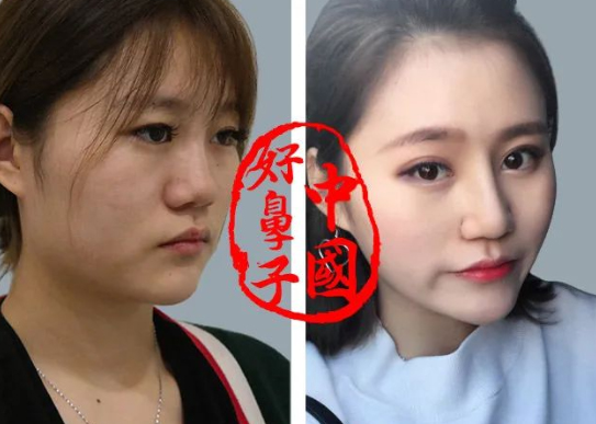 这些人不适合做鼻整形！