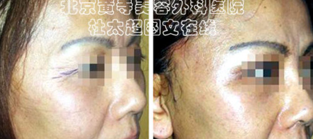 眼部皱纹如何清除