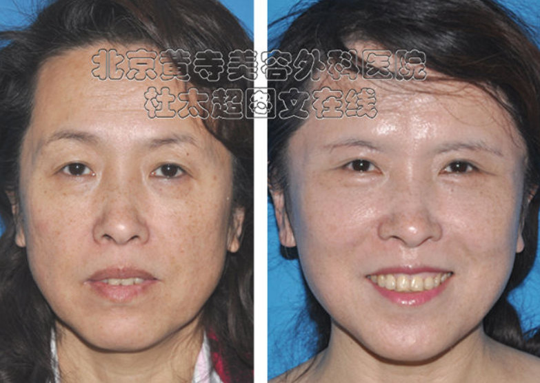 额纹祛除术效果怎么样