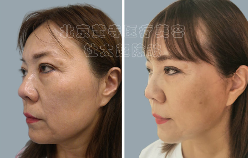 小切口面部提升术能维持多久