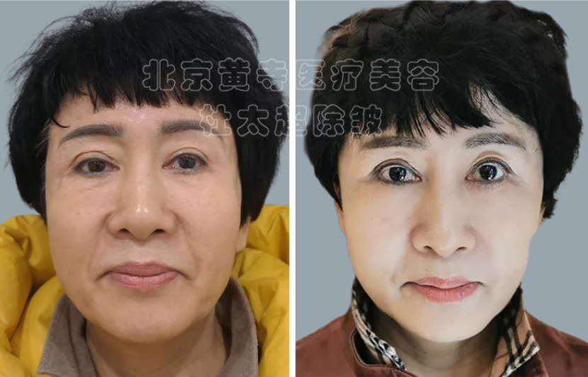 小切口除皱术的注意事项