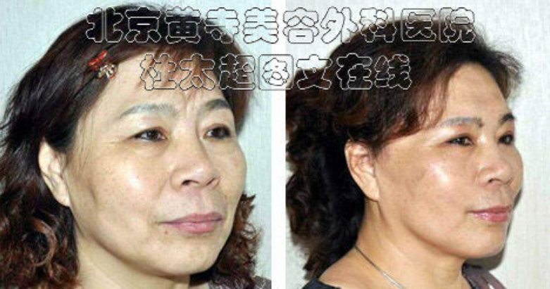 有什么方法能祛除眉间川字纹