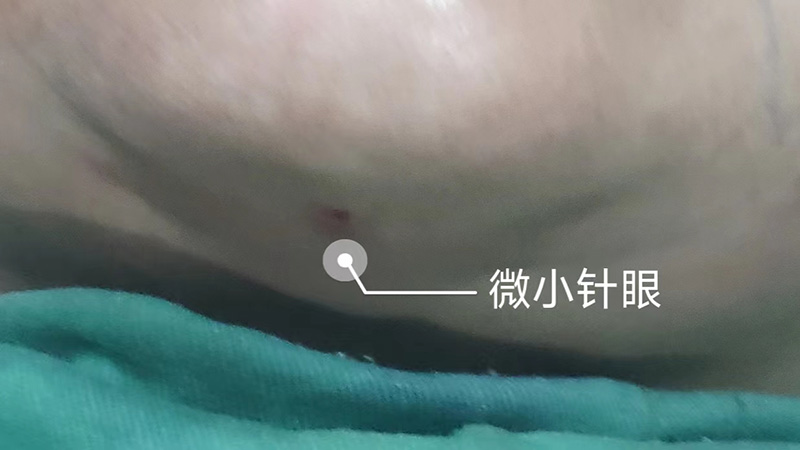 眼周、口周、法令纹及双下巴皮肤松弛治疗利器——Accutite