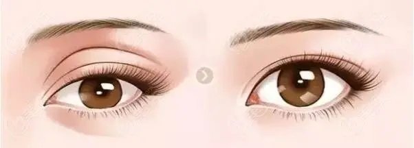 双眼皮手术须知！