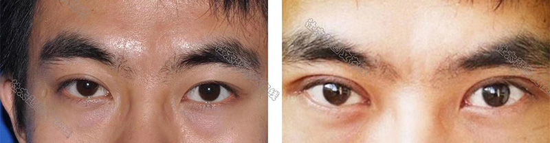 双眼皮手术须知！