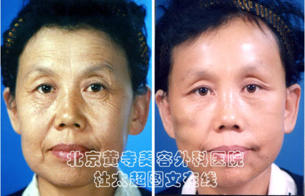 祛除眼部皱纹的方法