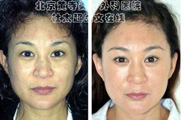 面部除皱都有几种方法