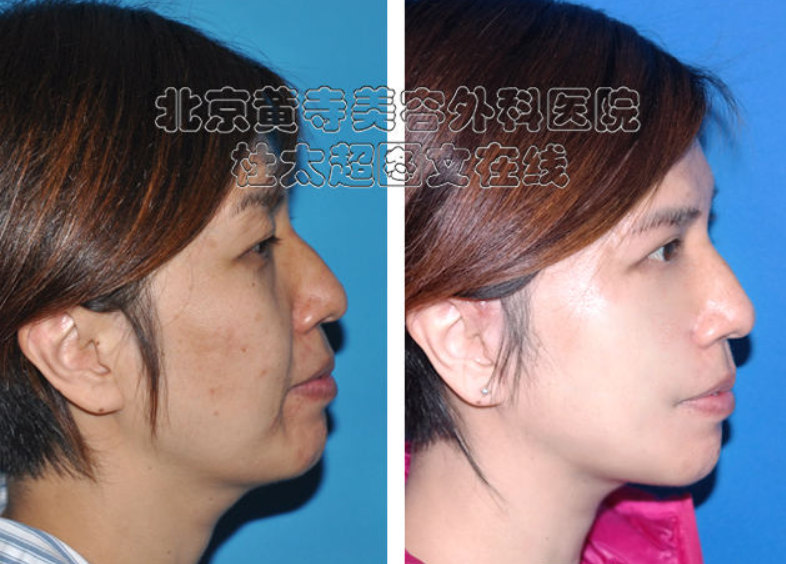 关于面部皱纹的了解