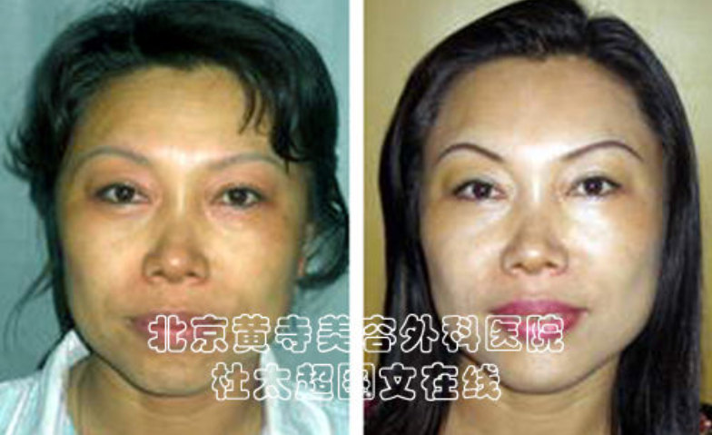 额纹祛除术有什么方法