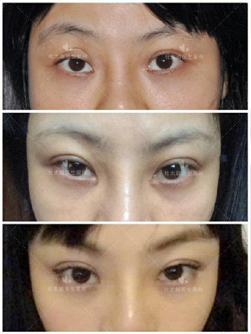 眼修复案例~典型的初眼成型失败案例