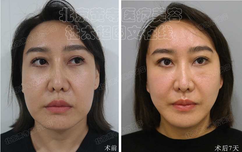 小切口面部提升术效果怎么样