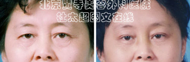 去除鱼尾纹有什么按摩手法