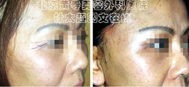 去除鱼尾纹的小方法