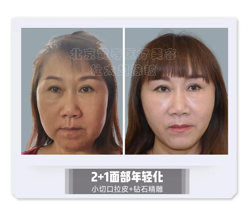 案例解读|从“满月脸”逆袭成“小V脸”，只需要3小时