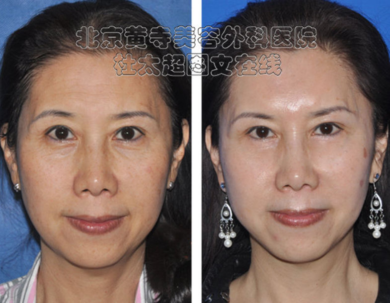 额部皱纹怎么去除效果好