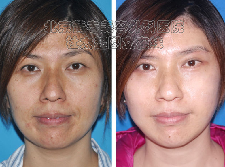 面部提升术的方法有哪些