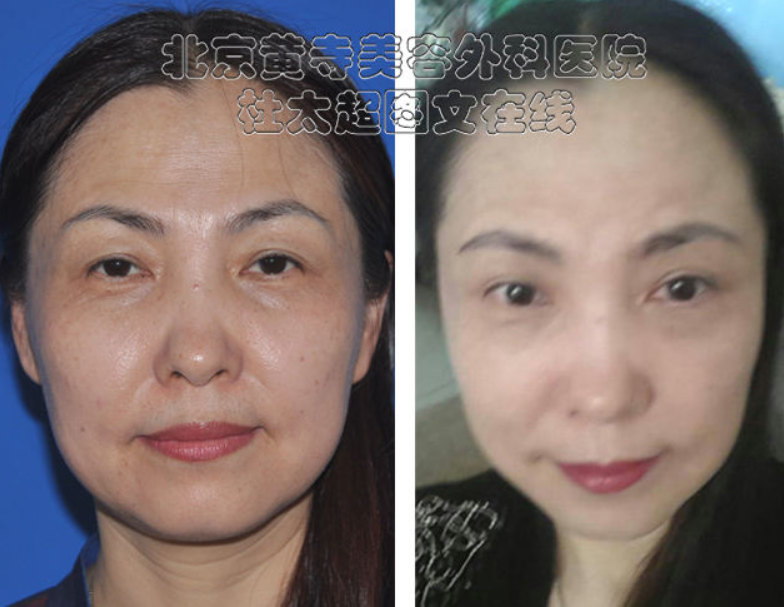 什么是额部皱纹除皱术