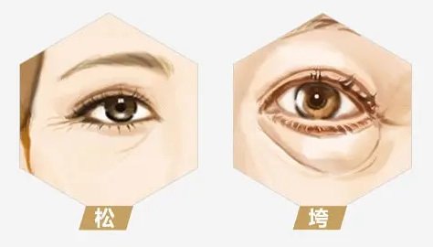 眼袋手术能解决多少个问题？