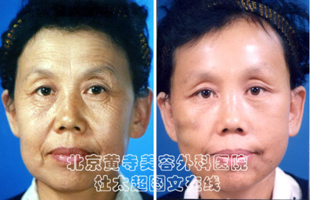 眼部去除皱纹最好的办法