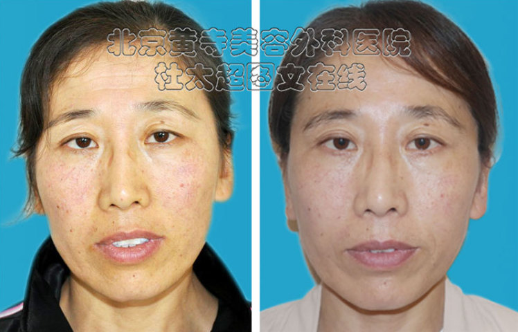 祛除眼部皱纹的小妙招