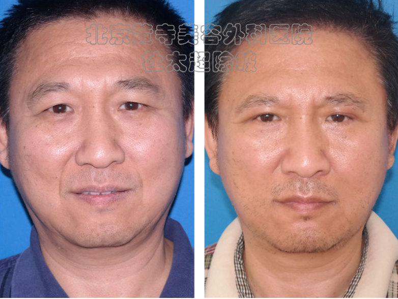 额头皱纹怎么祛除