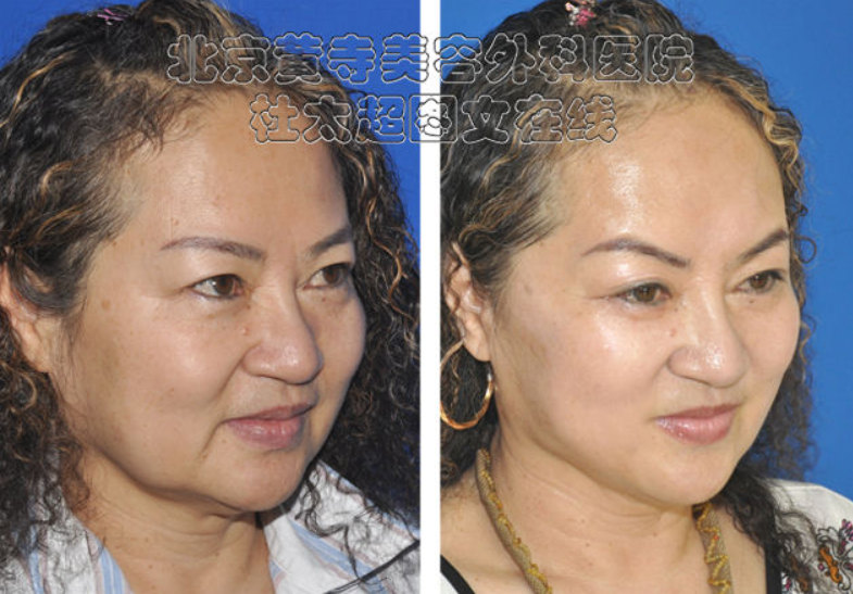 川字纹怎么祛除效果好