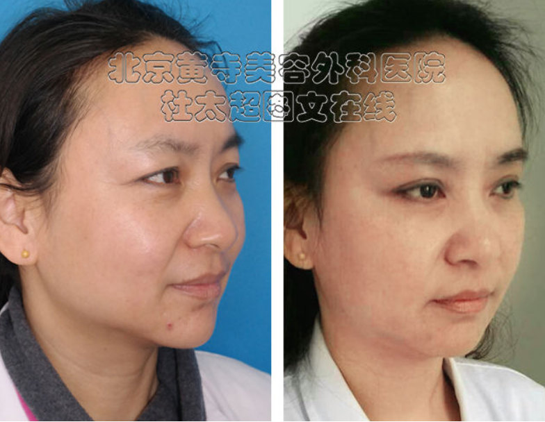 小切口面部提升术是什么