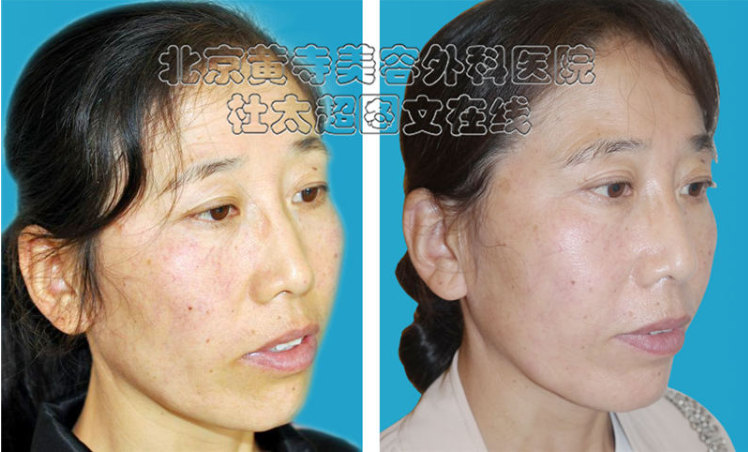 鱼尾纹怎么改善