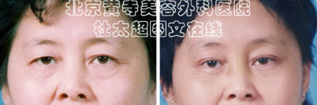 怎么预防鱼尾纹