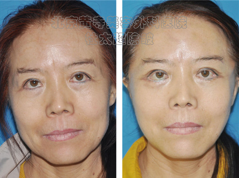 抬头纹出现是什么原因导致的呢