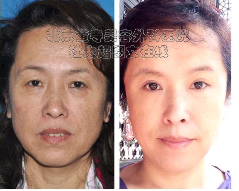 面部提升术恢复需要多久