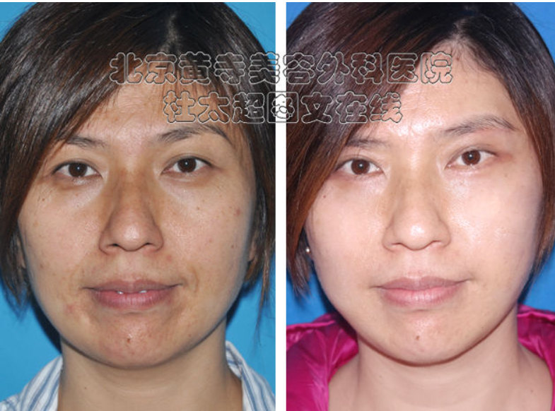 面部提升术后的注意事项