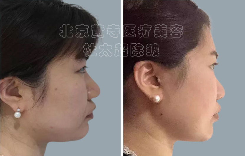 面部提升术后多久能消肿