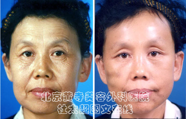 怎样去除眼角的鱼尾纹